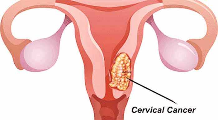 জরায়ুর টিউমার হলে কি করবেন?