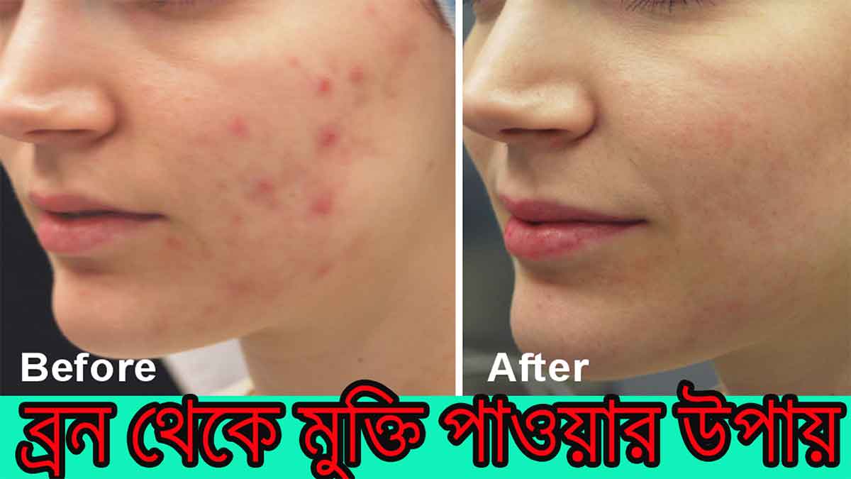 ব্রণের দাগ দূর করার উপায়